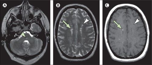 
Hội chứng lâm sàng riêng (Clinically isolated syndrome - CIS)
