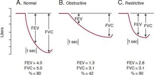 
Biểu đồ các dạng rối loạn thông khí: A: bình thường; B: rối loạn thông khí tắc nghẽn; C: rối loạn thông khí hạn chế.
