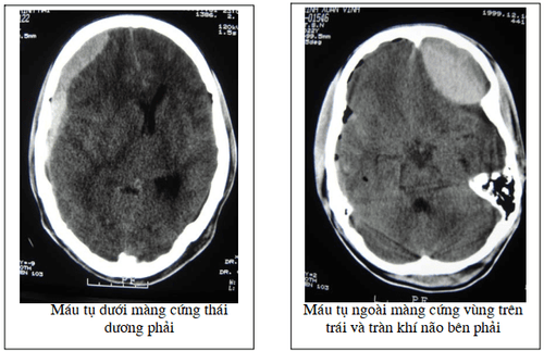 Computed tomography image of traumatic brain injury