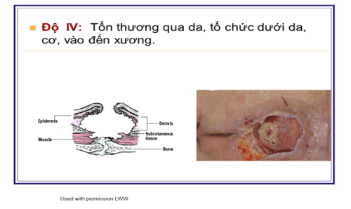 
Độ IV: Tổn thương qua da, tổ chức dưới da, cơ vào đến xương
