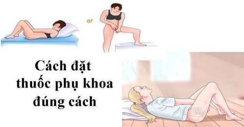 
Điều trị viêm cổ tử cung bằng thuốc cũng là cách được nhiều người áp dụng vì sự thuận tiện và dễ thực hiện
