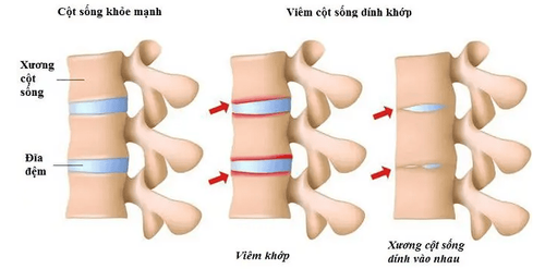 Các lựa chọn điều trị viêm cột sống dính khớp