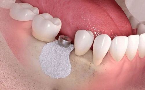 Cấy ghép Implant nên chọn gây tê hay gây mê?