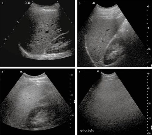 Ultrasound image of fatty liver