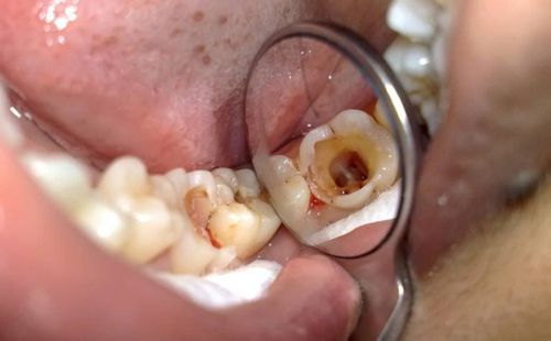 The pulp of the tooth is necrotic due to chronic pulpitis