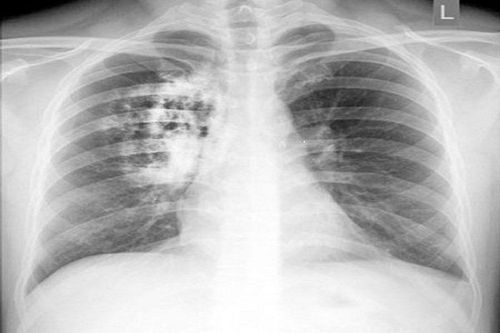 Tổn thương kính mờ hai đáy phổi là viêm phổi hay hen và điều trị bằng loại kháng sinh nào?