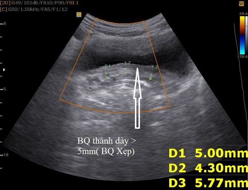 What does bladder wall thickening on ultrasound indicate?