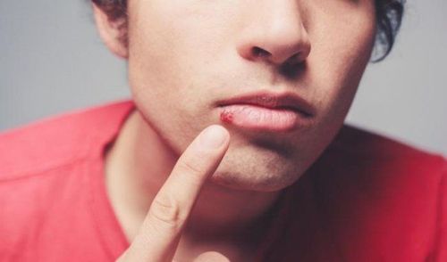 What are cold sores?