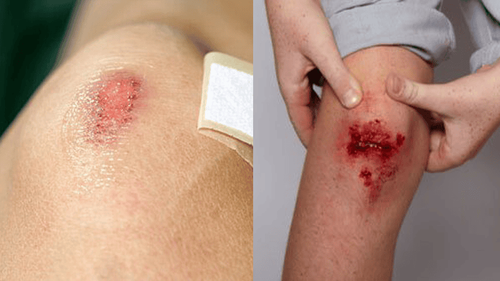 First aid and care for broken skin