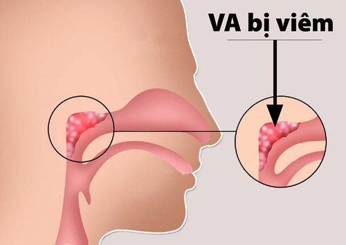 Trẻ viêm VA mũi uống thuốc không khỏi phải làm sao?