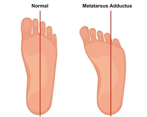 
Dị tật bàn chân cong vào trong - metatarsus Adductus
