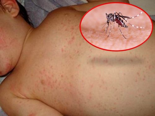 Nguyên nhân gây giảm tiểu cầu của người nhiễm sốt xuất huyết Dengue