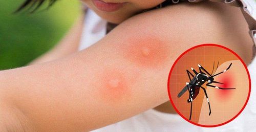 Dengue fever without rash: Why and how?