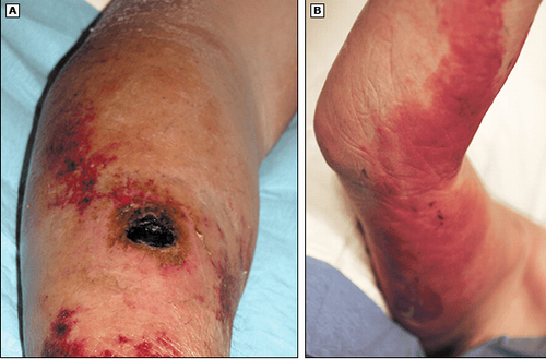 Hình 2: Cutaneous anthrax with lymphangitis