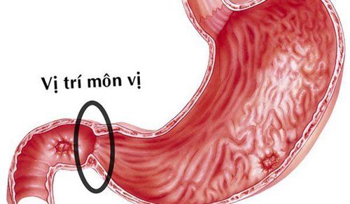 
Hình ảnh vị trí môn vị
