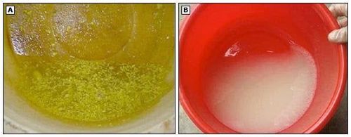 Acute diarrhea in adults