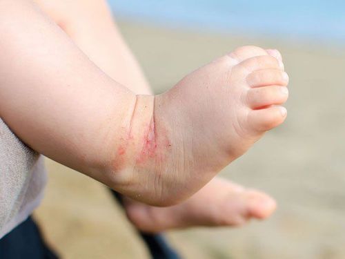 How to treat insect bites in children?