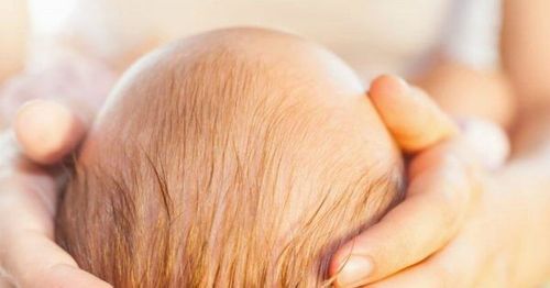 Flat head syndrome in babies