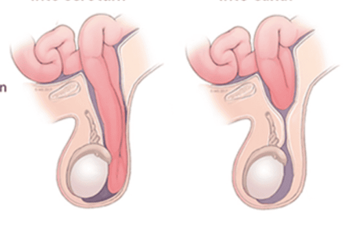 
Chứng thoát vị bẹn có thể là nguyên nhân gây sưng tinh hoàn ở trẻ
