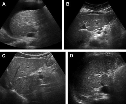 
Hình ảnh xơ gan: Siêu âm cắt đứng dọc (A) bộc lộ nốt bề mặt, dịch ổ bụng và nhu mô thô. Các ảnh đứng dọc cho thấy (B) phì đại phân thùy ngoài, (C) phì đại thùy đuôi, và (D) teo thùy phải.
