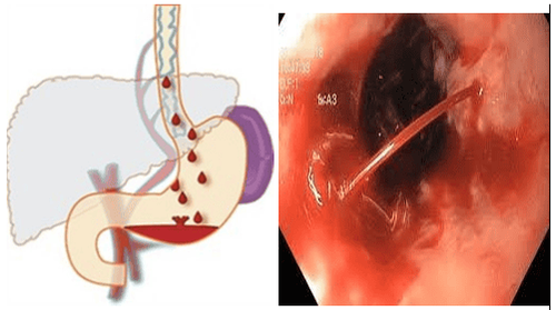 
Xuất huyết tiêu hóa do vỡ dãn tĩnh mạch thực quản – hậu quả của giãn tĩnh mạch thực quản không được điều trị
