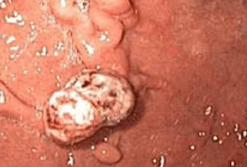 
Polyp vị thành niên. A: Polyp ở trẻ vị thành niên là những polyp dạng hamartomatous và thường được tìm thấy trong động vật có vú. Polyp đơn độc có các thành phần mô mỡ hoặc viêm. Polyp vị thành niên ít đặc hiệu hơn về mặt mô học so với polyp Peutz-Jeghers và đôi khi được gọi là polyp viêm hoặc u khi không liên quan đến hội chứng.
