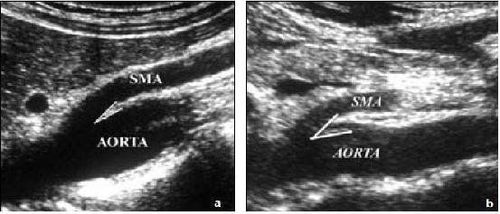 
Đo góc giữa ĐMTTT và ĐM chủ bụng. A, đo được 70. B, 320. Nguồn: Birsen Ünal et al. Superior mesenteric artery syndrome: CT and ultrasonography findings. Diagn Interv Radiol 2005; 11:91
