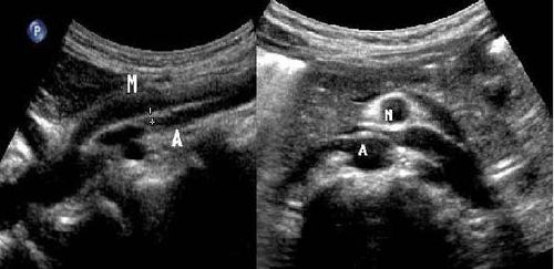 
Mặt cắt dọc và ngang trên siêu âm của bệnh nhân này cho thấy hẹp góc và khoảng cách ĐMTTT và ĐM chủ bụng. Nguồn: Usman Javaid, A.R. Mustafawi, Munir ahmad. The Superior Mesenteric Artery Syndrome (SMAS): Is it really a diagnostic dilemma? Annals of Pediatric Surgery Vol 5, No 3, July 2009, PP 206
