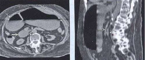 
Hội chứng ĐM TTT ở do bị vẹo cột sống ra trước gây hẹp góc. Nguồn: Michael R Federle. SMA syndrome. In: Michael R Federle. Diagnostic imaging: Abdomen. Amirsys 2010: I-4-14
