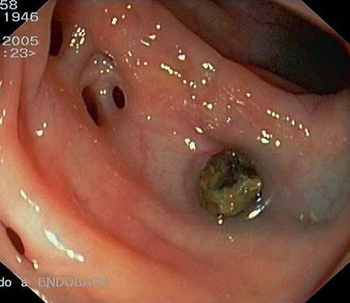 
Túi thừa ĐT với hình ảnh sỏi phân bên trong
