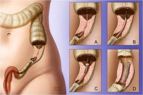 
Stent đại tràng được sử dụng để giải áp chỗ hẹp của đại tràng
