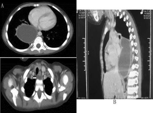 Overview of double esophageal cyst disease