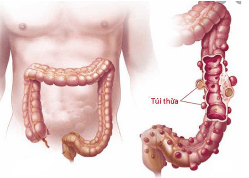 
Hình 1: Bệnh lý túi thừa đại tràng
