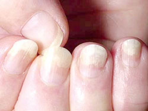 Nail deformity and nail dystrophy