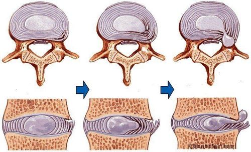 
Minh hoạ đĩa đệm và rách bao xơ - thoát vị
