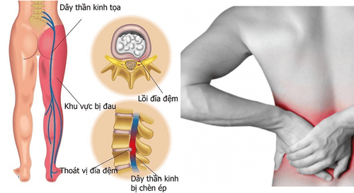 
Hình 4: Minh hoạ thoát vị đĩa đệm gây chèn ép rễ thần kinh sống
