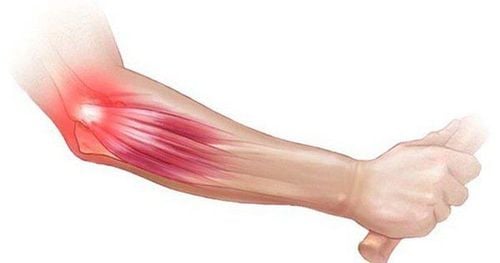 
Viêm gân do hội chứng tennis elbow
