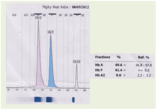 
Kết quả hemoglobin
