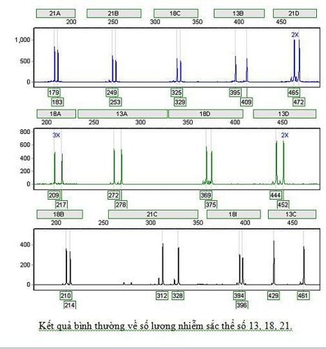 
Kết quả xét nghiệm QF-PCR bình thường
