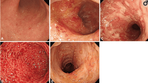 
Nội soi điển hình của viêm loét đại tràng. (A) Nhẹ: sinh huyết niêm mạc, hạt mịn, mạch máu giảm. (B) Viêm mức độ trung bình: sung huyết rõ rệt, mất mạch máu, ăn mòn niêm mạc. (C) Mức độ nặng: loét. (D) Nặng: chảy máu tự phát. (E) Hẹp ống tiêu hoá kèm giả mạc.
