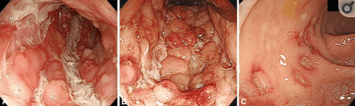 
Đặc điểm nội soi điển hình của bệnh Crohn. (A) Loét dọc, (B) xuất hiện hình ảnh đá cuội, (C) loét áp-tơ theo mảng dọc.
