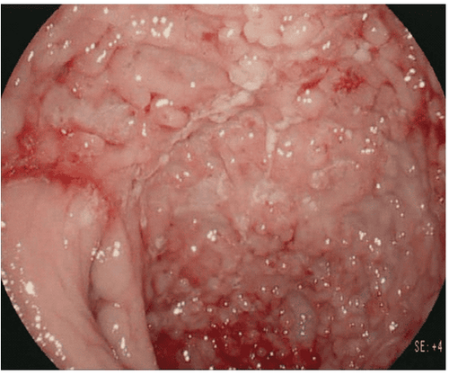 
Nội soi ánh sáng trắng độ nét cao của bệnh Crohn nặng với nhiều vết loét dọc và xuất huyết tự phát của niêm mạc bị viêm.
