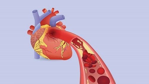 Silent myocardial ischemia