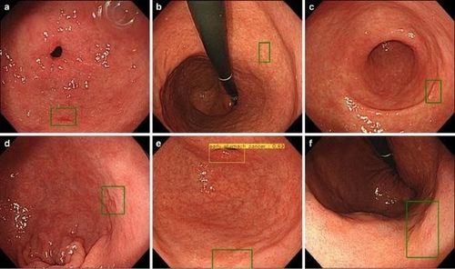 
Hình ảnh trí tuệ nhân tạo tự động tìm tổn thương và đánh giá khả năng ung thư ở dạ dày
