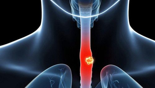 Current methods of diagnosing esophageal cancer