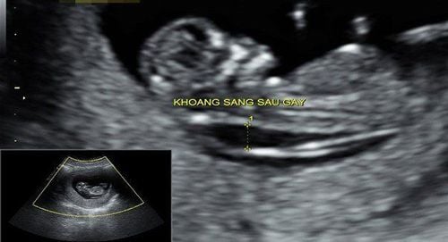 Is it okay for a 12-week-old fetus to have a light space at the back of the neck of 3.4mm?