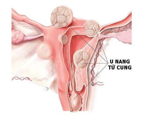 When are drugs used to treat uterine fibroids?