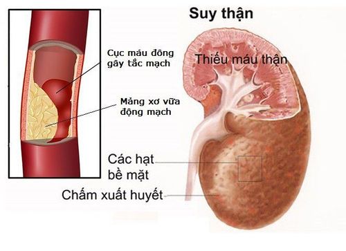 
Cục máu đông ở thận có thể gây suy thận
