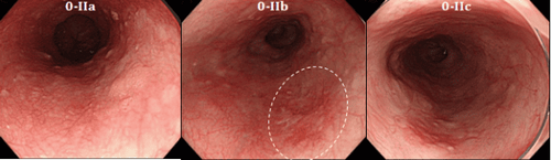 
Hình 2: Ung thư thực quản giai đoạn sớm được nhìn thấy qua nội soi
