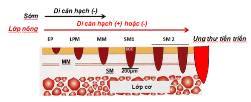 
Hình 3: Phân chia giai đoạn của ung thư sớm thực quản
